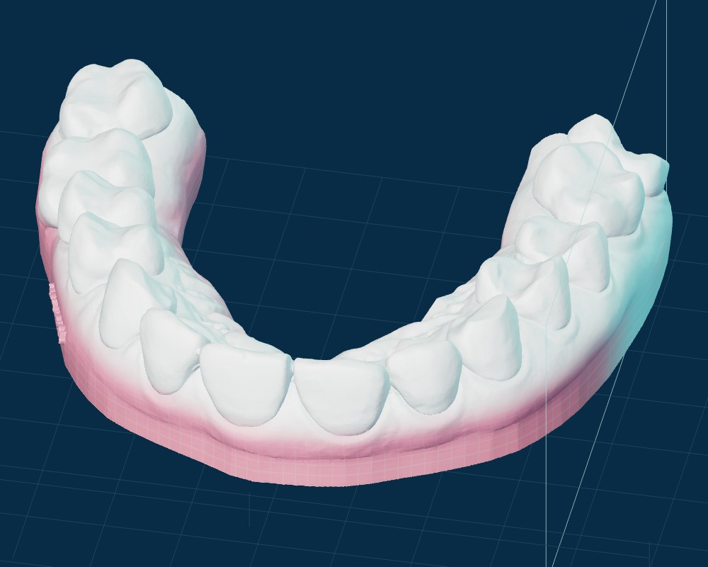 Upper-arch scan model with a seated clear aligner.