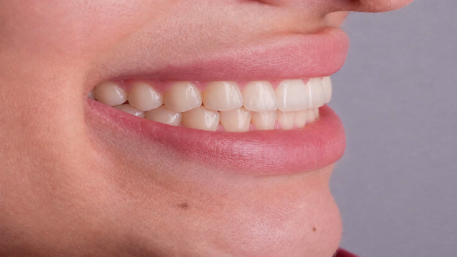 Smile after treatment