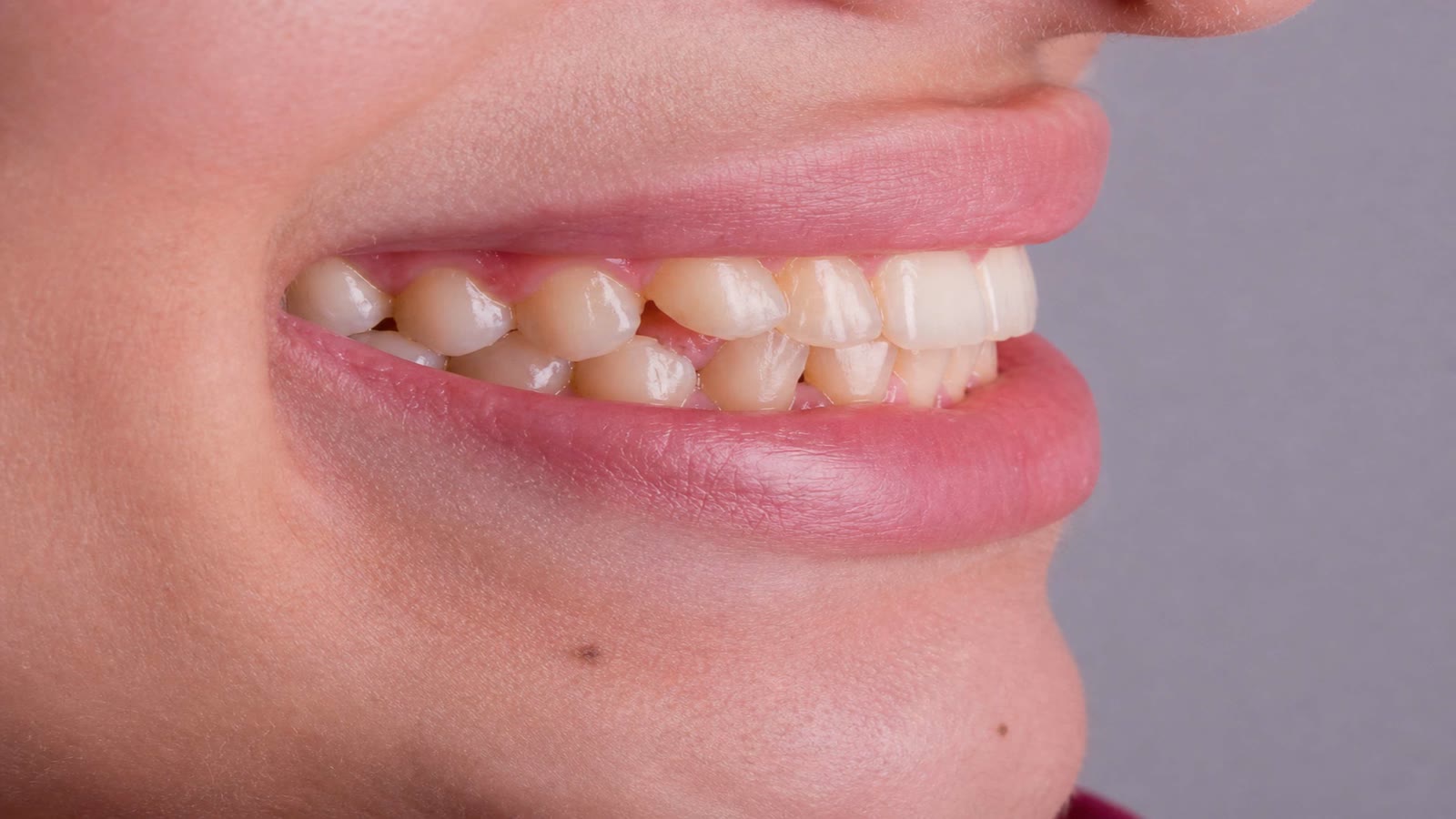 Smile before treatment