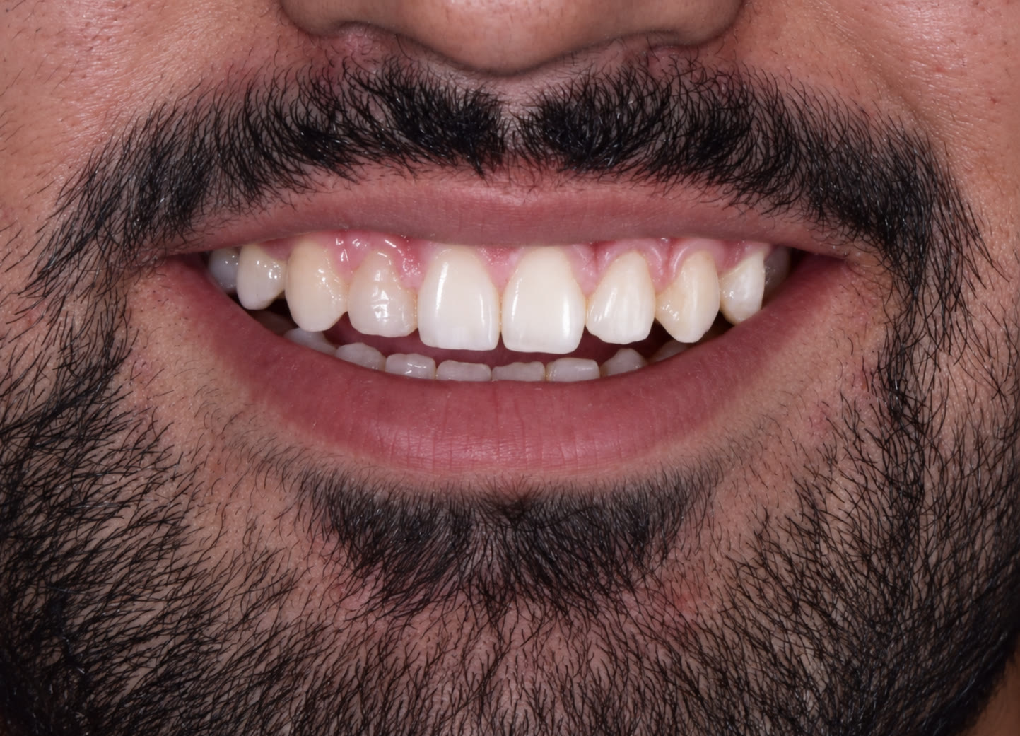 Front-view smile after treatment