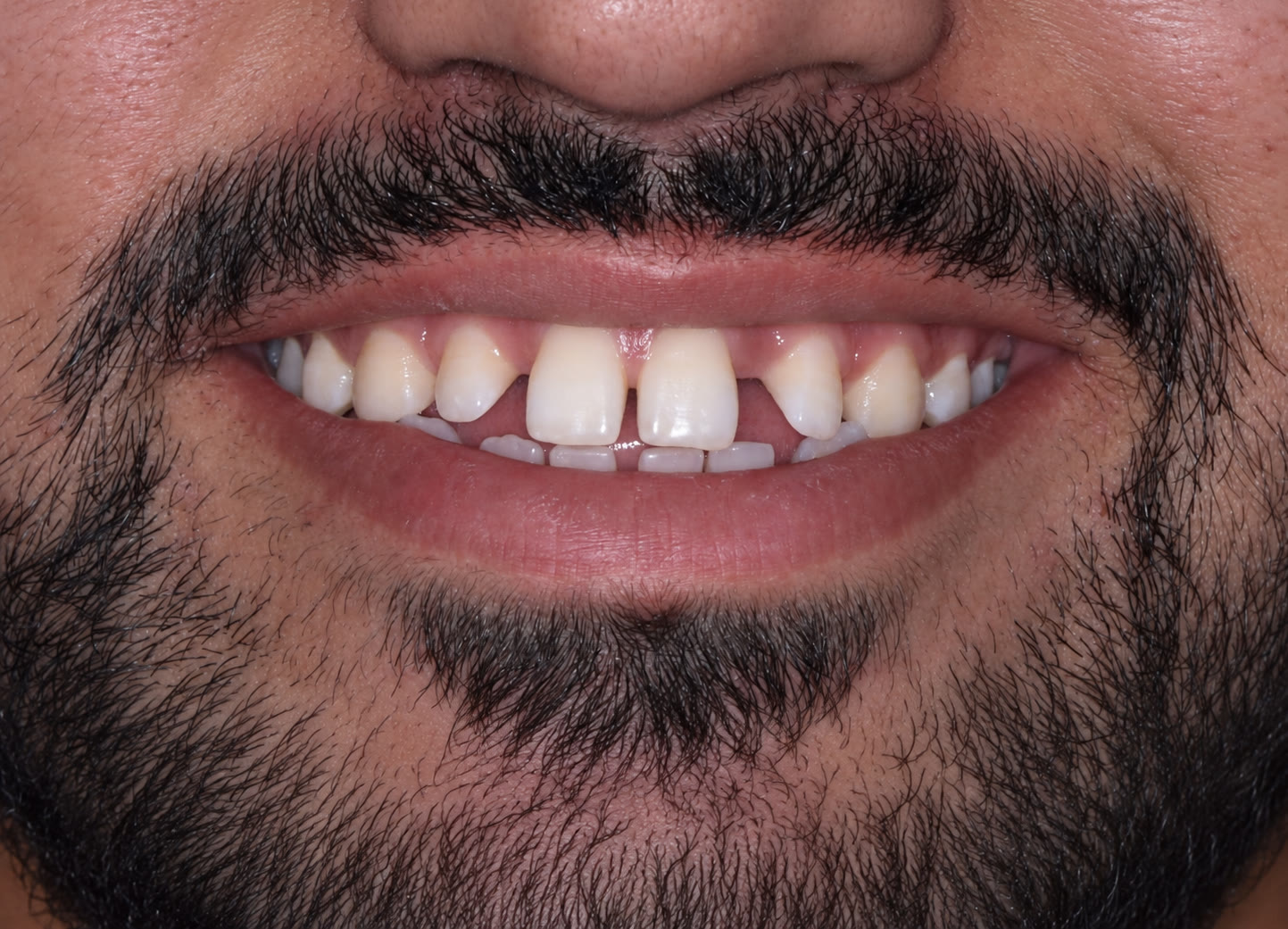 Front-view smile before treatment